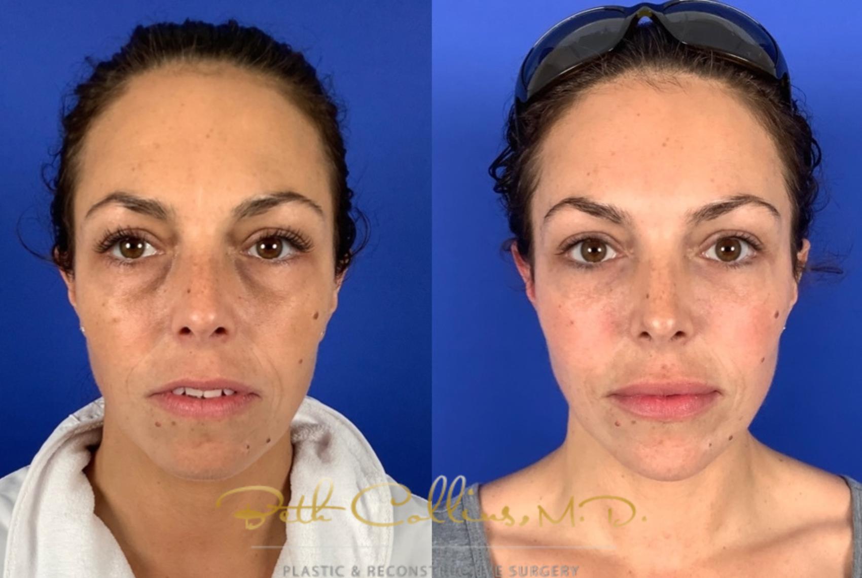 Before & After JUVÉDERM® Case 225 Front View in Guilford, CT