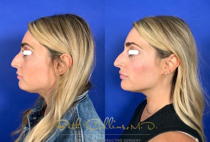 Before & After JUVÉDERM® Case 251 Left Side View in Guilford, CT