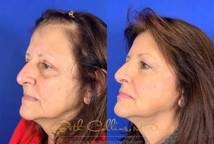 Before & After JUVÉDERM® Case 252 Left Side View in Guilford, CT
