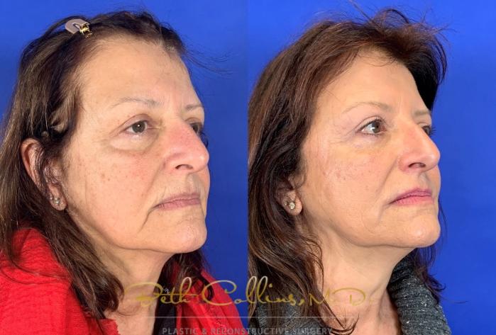 Before & After JUVÉDERM® Case 252 Right Oblique View in Guilford, CT