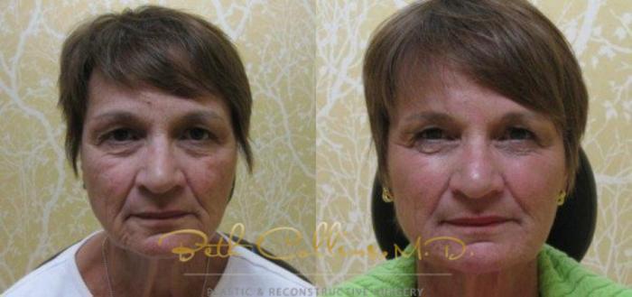 Before & After JUVÉDERM® Case 57 View #1 View in Guilford, CT
