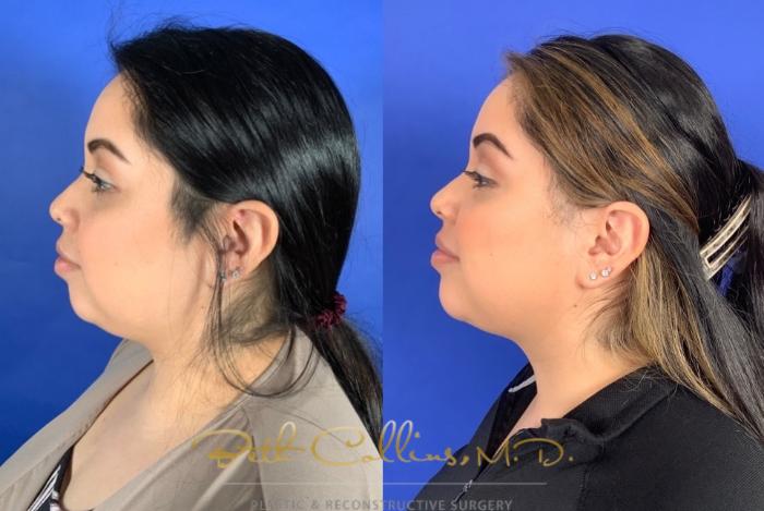 Before & After KYBELLA™ Case 210 Left Side View in Guilford, CT