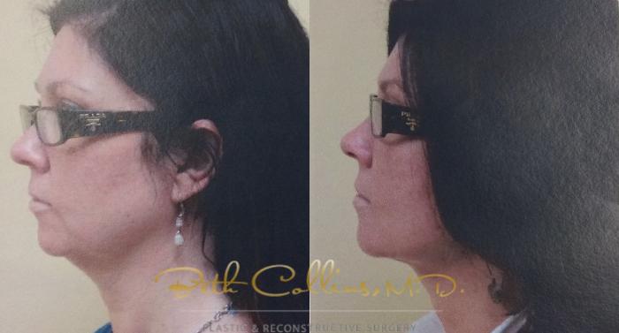 Before & After KYBELLA™ Case 58 View #2 View in Guilford, CT