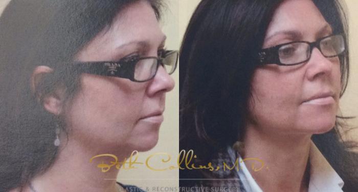 Before & After KYBELLA™ Case 58 View #3 View in Guilford, CT