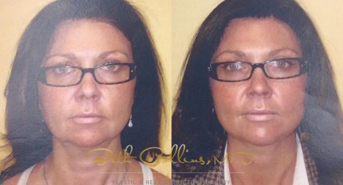 Before & After KYBELLA™ Case 58 View #4 View in Guilford, CT