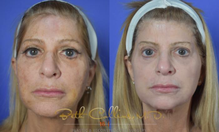 Before & After Laser Procedures Case 109 View #1 View in Guilford, CT