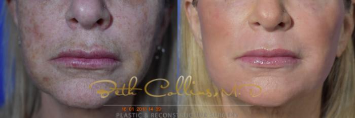 Before & After Laser Procedures Case 109 View #2 View in Guilford, CT