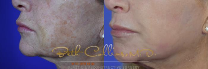 Before & After Laser Procedures Case 109 View #3 View in Guilford, CT