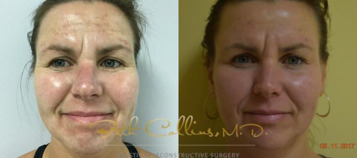 Before & After Laser Procedures Case 112 View #1 View in Guilford, CT