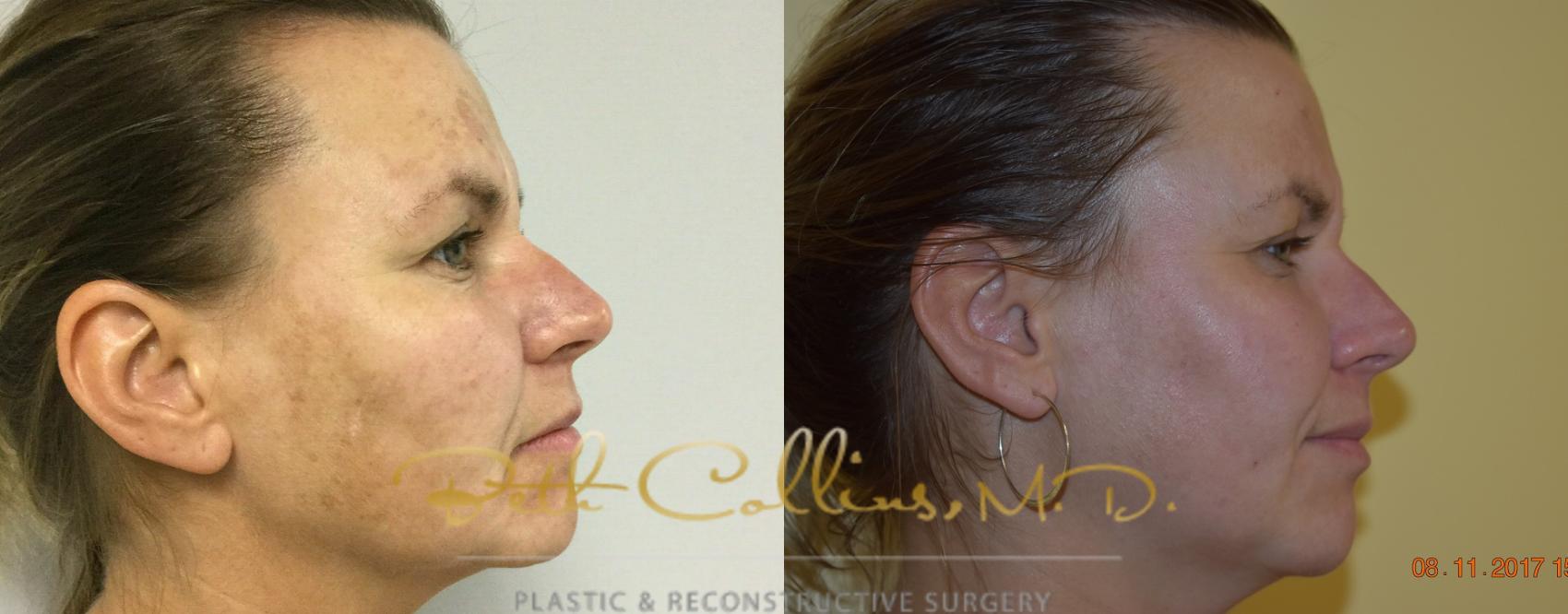 Before & After Laser Procedures Case 112 View #2 View in Guilford, CT