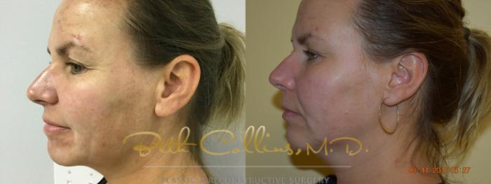Before & After Laser Procedures Case 112 View #3 View in Guilford, CT
