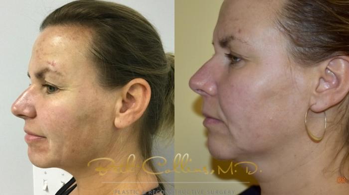 Before & After Laser Procedures Case 159 Left Side View in Guilford, CT