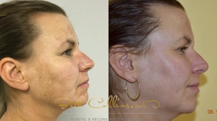 Before & After Laser Procedures Case 159 Right Side View in Guilford, CT