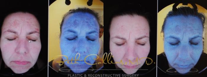 Before & After Laser Procedures Case 159 UV Camera: Dermal Improvements View in Guilford, CT