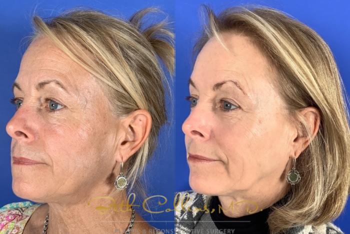 Before & After Laser Procedures Case 211 Left Oblique View in Guilford, CT