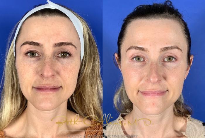 Before & After Laser Procedures Case 212 Front View in Guilford, CT
