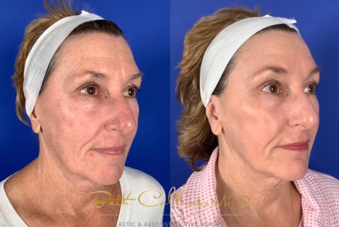 Before & After Laser Procedures Case 226 Right Oblique View in Guilford, CT