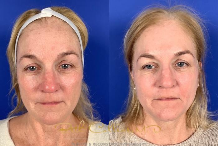 Before & After Laser Procedures Case 227 Front View in Guilford, CT