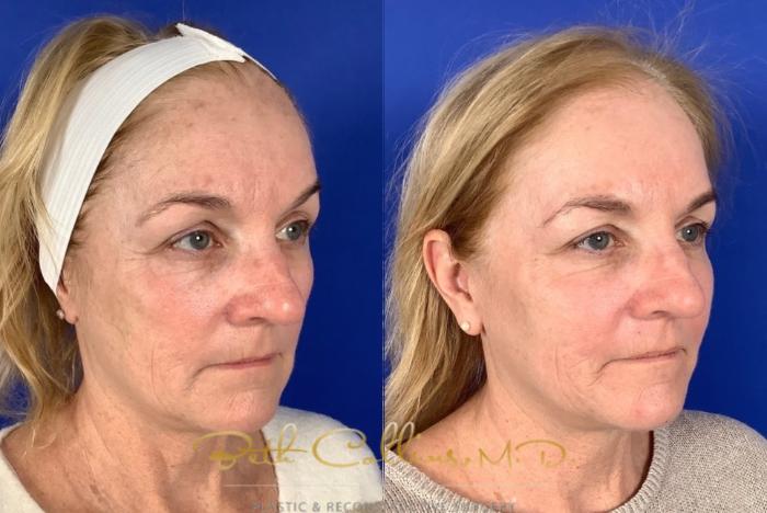 Before & After Laser Procedures Case 227 Right Oblique View in Guilford, CT