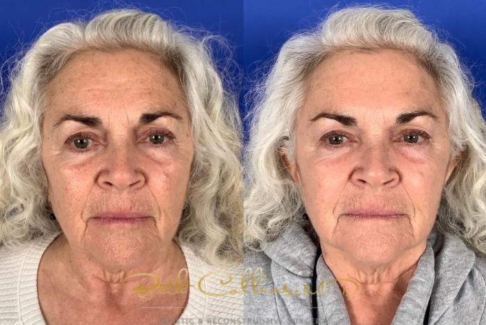 Before & After Laser Procedures Case 228 Front View in Guilford, CT