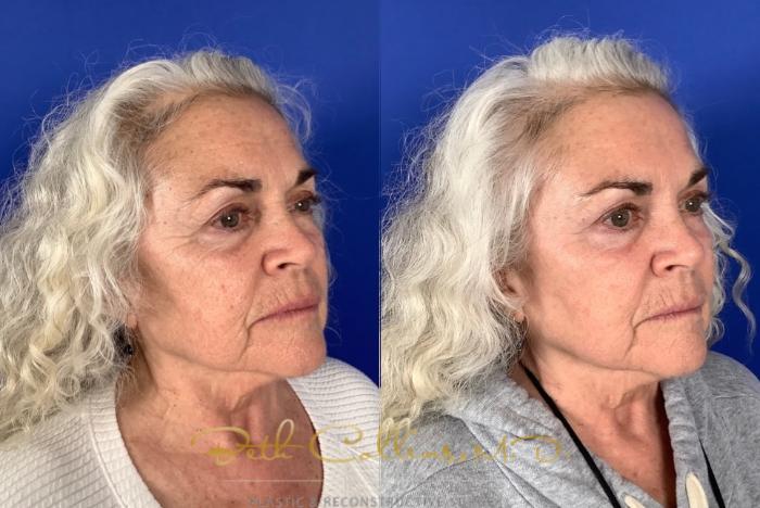 Before & After Laser Procedures Case 228 Right Oblique View in Guilford, CT