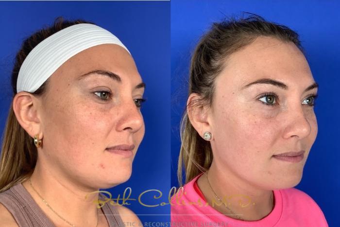 Before & After Laser Procedures Case 229 Right Oblique View in Guilford, CT