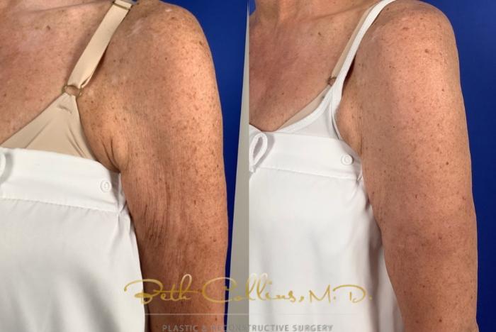 Before & After Laser Procedures Case 231 Front View in Guilford, CT