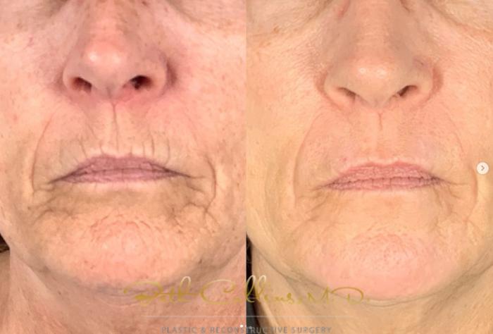 Before & After Laser Procedures Case 275 Front View in Guilford, CT