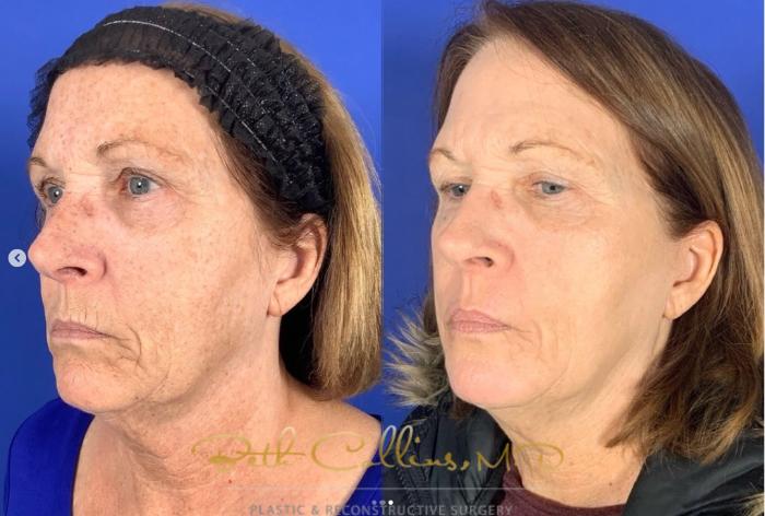 Before & After Laser Procedures Case 275 Left Oblique View in Guilford, CT