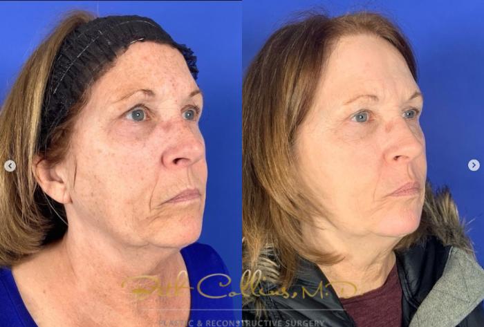 Before & After Laser Procedures Case 275 Right Oblique View in Guilford, CT