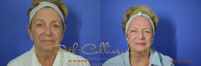 Before & After Laser Procedures Case 98 View #1 View in Guilford, CT