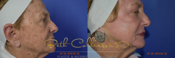 Before & After Laser Procedures Case 98 View #4 View in Guilford, CT