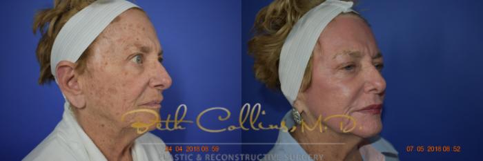 Before & After Laser Procedures Case 98 View #5 View in Guilford, CT