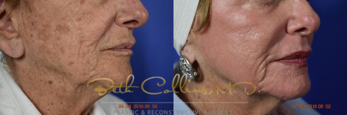 Before & After Laser Procedures Case 98 View #6 View in Guilford, CT