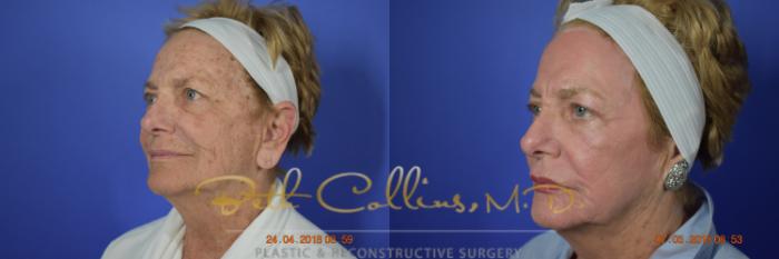 Before & After Laser Procedures Case 98 View #7 View in Guilford, CT