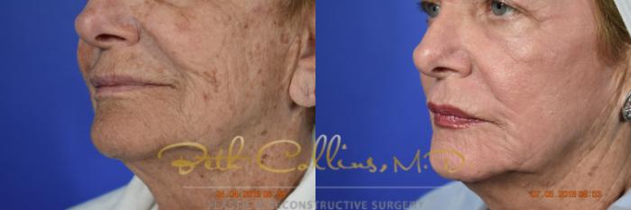 Before & After Laser Procedures Case 98 View #8 View in Guilford, CT