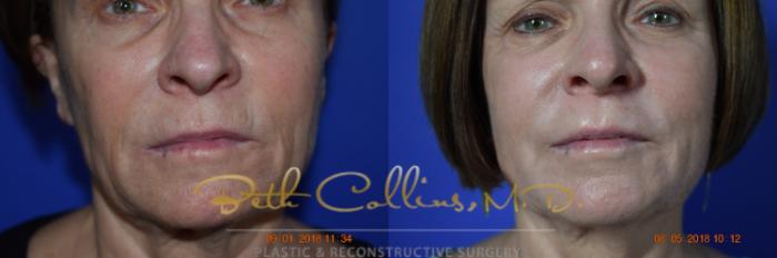 Before & After Laser Procedures Case 99 View #2 View in Guilford, CT