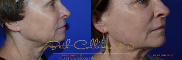 Before & After Laser Procedures Case 99 View #4 View in Guilford, CT