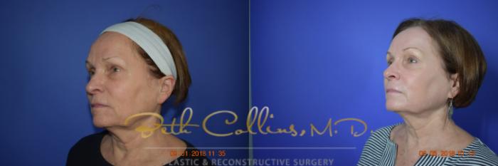 Before & After Laser Procedures Case 99 View #5 View in Guilford, CT