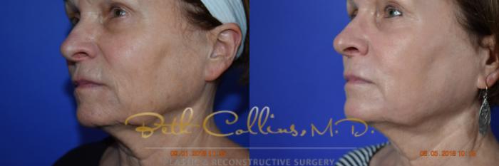 Before & After Laser Procedures Case 99 View #6 View in Guilford, CT