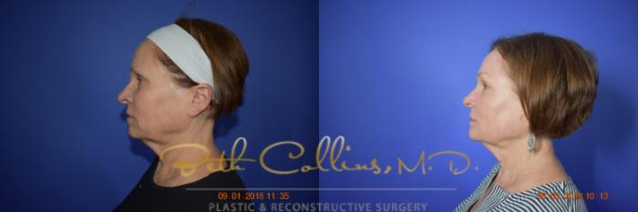 Before & After Laser Procedures Case 99 View #7 View in Guilford, CT