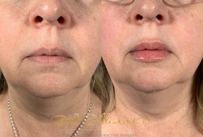 Before & After Lip Filler Case 213 Front View in Guilford, CT