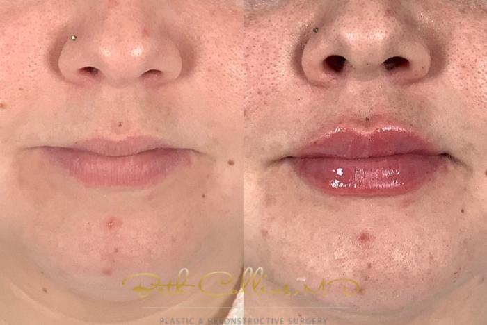 Before & After Lip Filler Case 214 Front View in Guilford, CT
