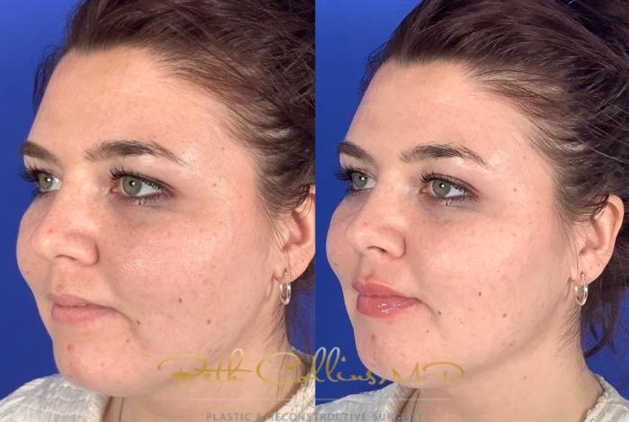 Before & After Lip Filler Case 214 Left Oblique View in Guilford, CT