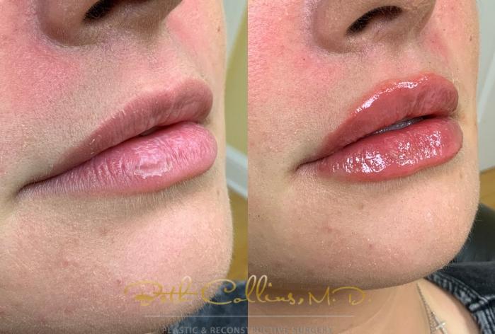 Before & After Lip Filler Case 215 Right Oblique View in Guilford, CT