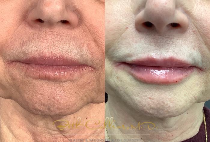 Before & After JUVÉDERM® Case 216 Front View in Guilford, CT
