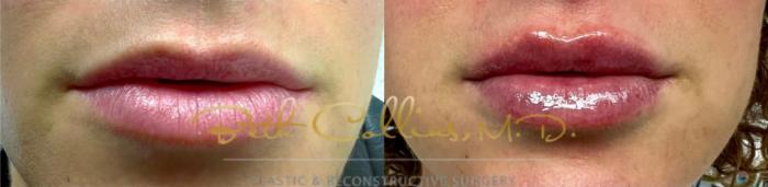 Before & After JUVÉDERM® Case 217 Front View in Guilford, CT