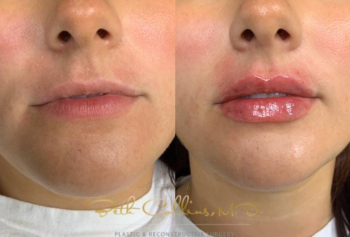 Before & After Lip Filler Case 218 Front View in Guilford, CT