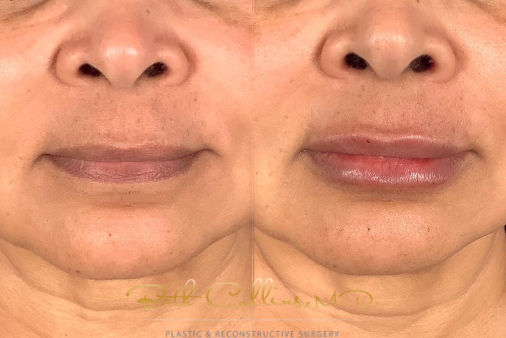 Before & After Lip Filler Case 230 Front View in Guilford, CT