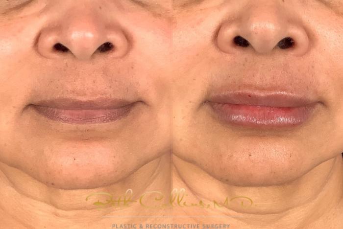 Before & After JUVÉDERM® Case 230 Front View in Guilford, CT